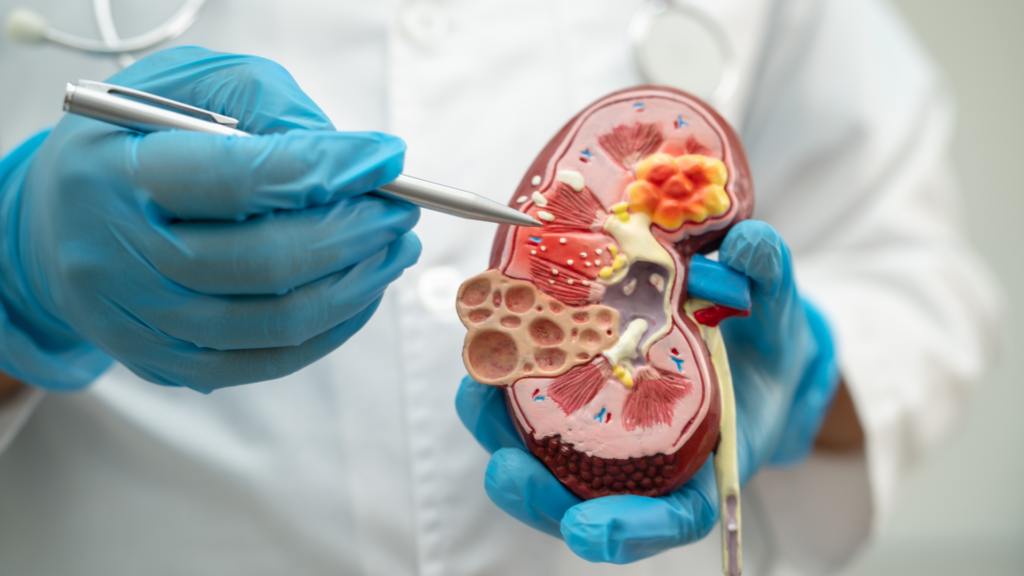 Kidney Stone Treatment In Delhi